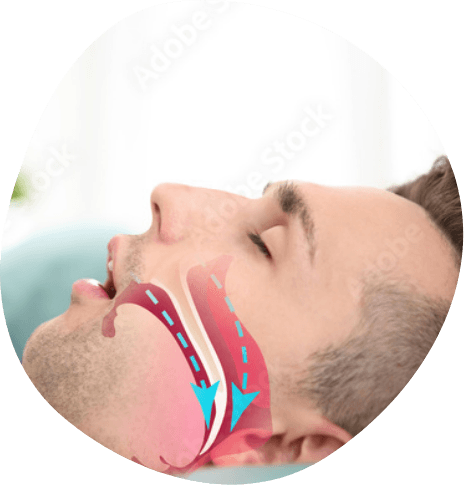 Side profile of sleeping man with animated blocked airway